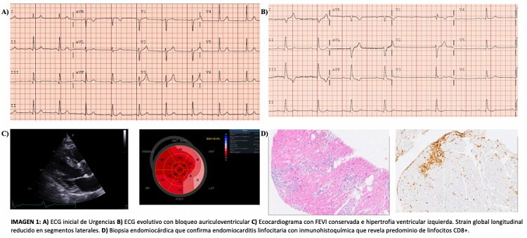 Miocarditis Por Immune Checkpoint Inhibitors Caso Cl Nico Revista