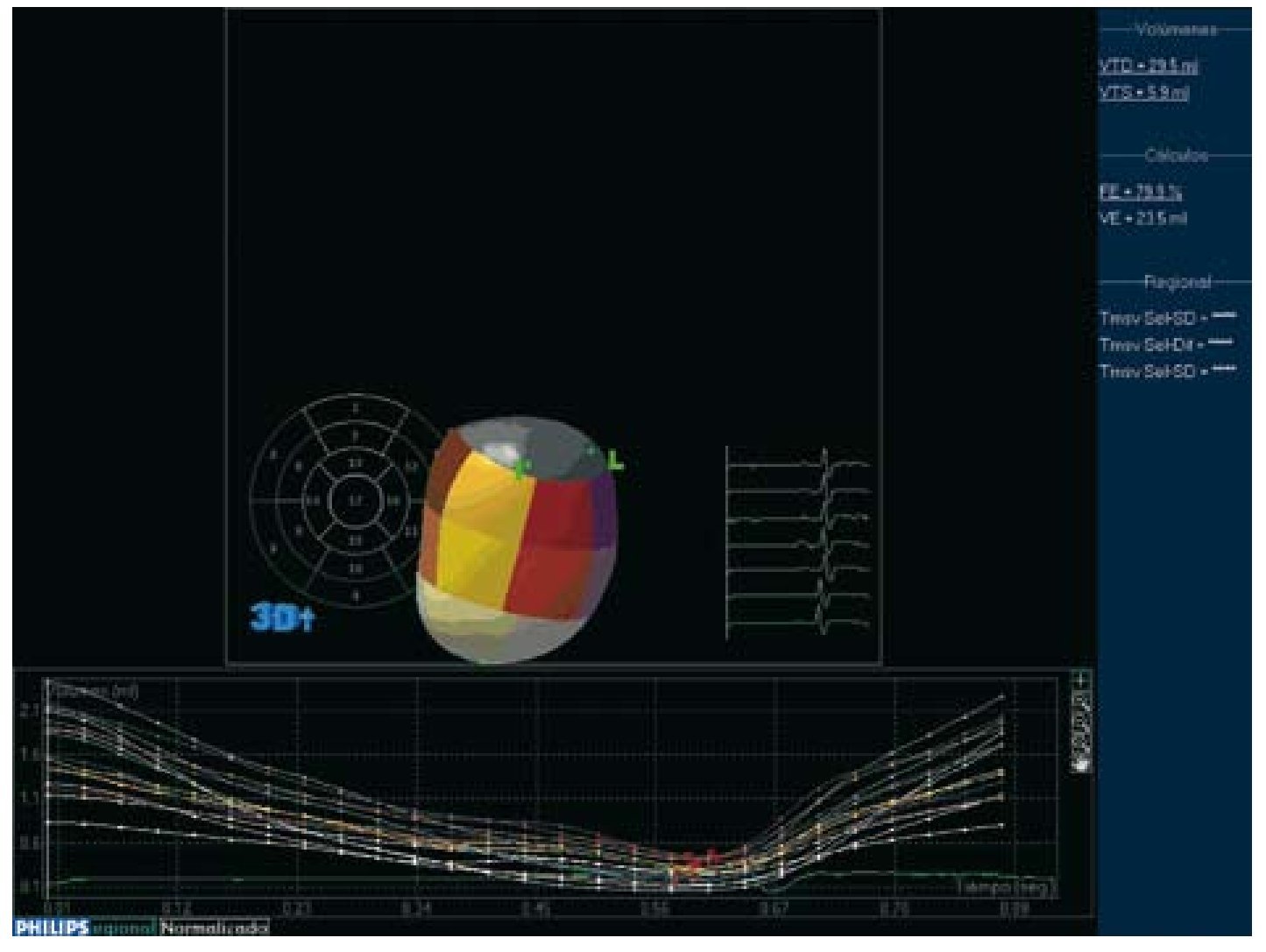 Three Dimensional Echocardiographic Assessment Of Left Atrial Size And