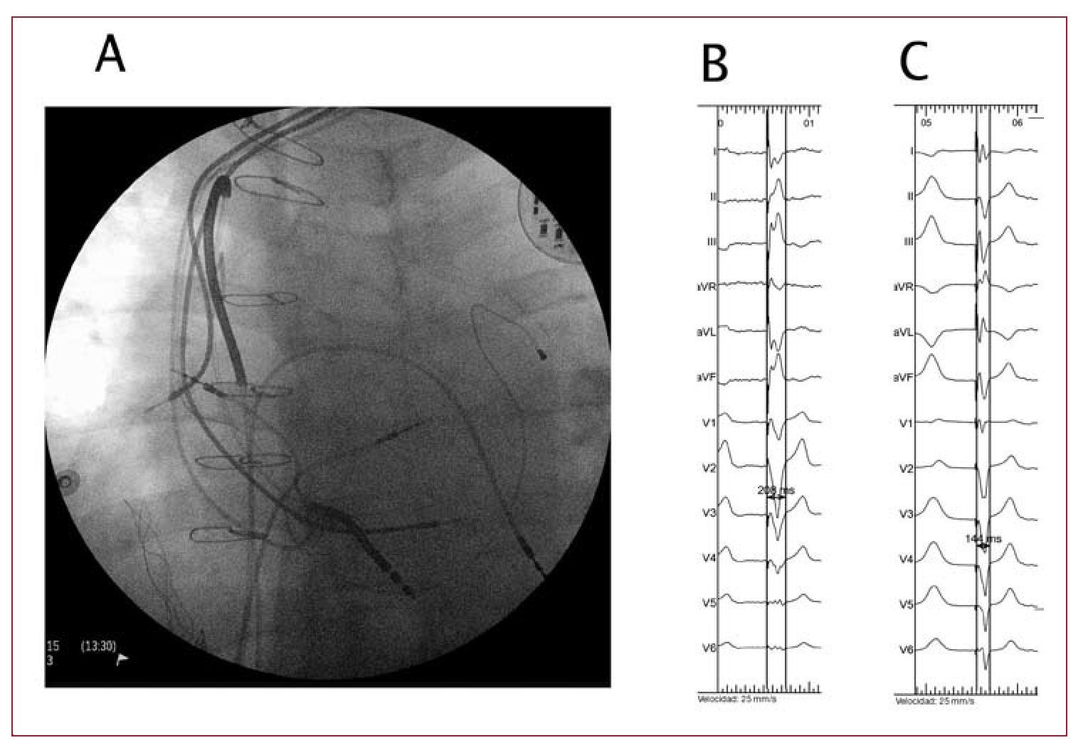 Implantation Via The Femoral Vein Of A Biventricular Defibrillator With