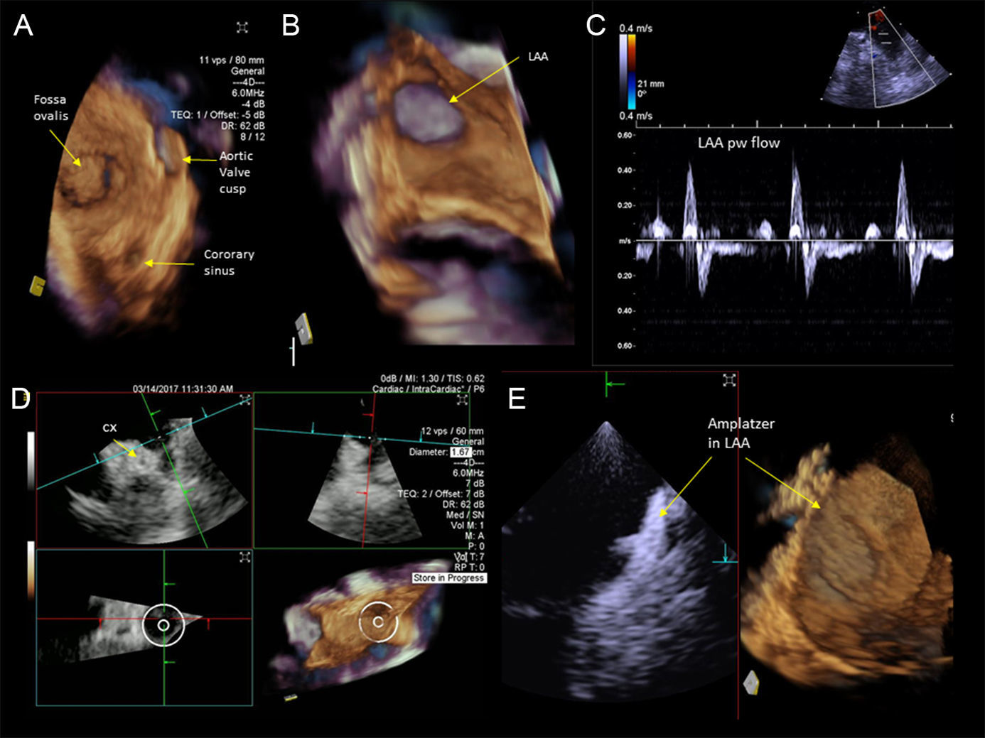 New Catheter Wide Angle Imaging D Intracardiac Echocardiography