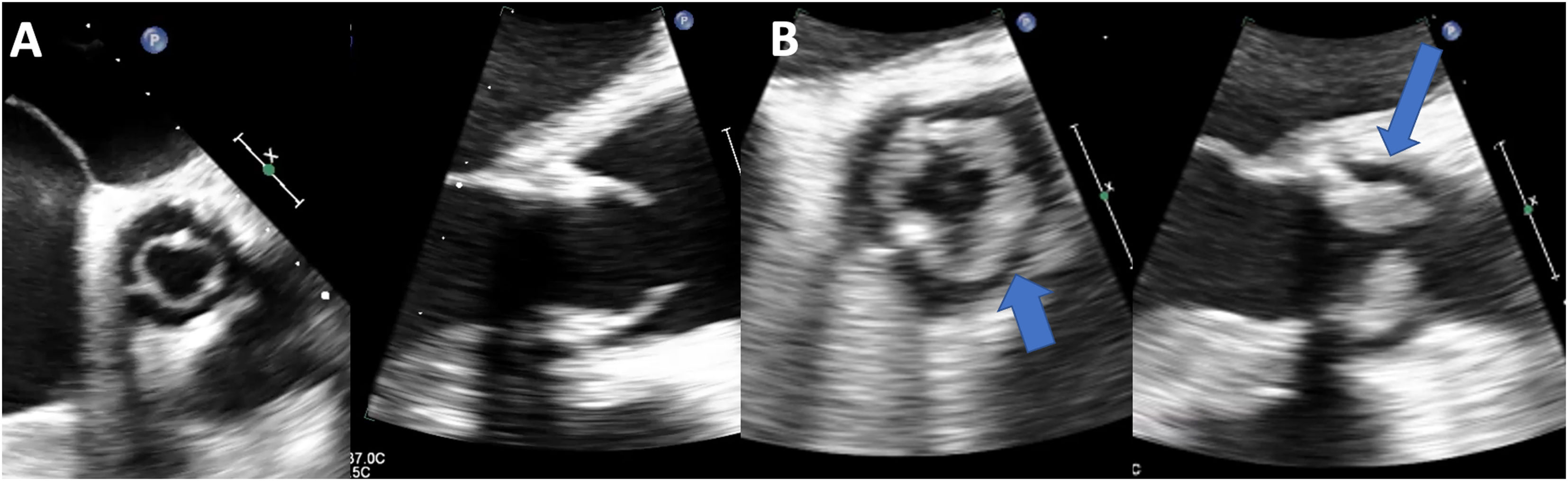 Valvulitis A New Echocardiographic Criterion For The Diagnosis Of