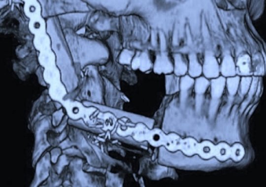 Reconstruyen la mandíbula de un paciente afectado por cáncer mediante  técnicas de 3D y cirugía poco invasiva - JANO.es - ELSEVIER