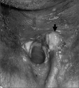 Fístula faringocutánea situada a nivel de la incisión quirúrgica a la izquierda del traqueostoma. La flecha señala el punto de salida de la saliva.