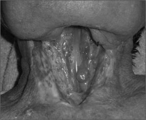 Gran faringostoma en la fase previa a la reconstrucción quirúrgica.