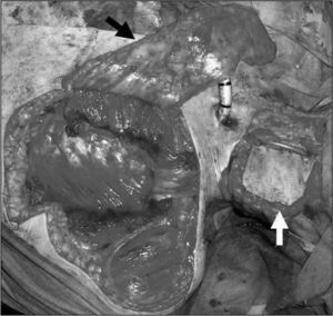 Imagen intraoperatoria del cierre de un gran faringostoma con colgajos regionales. La flecha negra señala el colgajo fasciocutáneo deltopectoral desplegado. La flecha blanca muestra el colgajo miocutáneo pectoral mayor suturado a un lado del remanente faríngeo en su ubicación prácticamente definitiva.