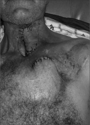 Resultado del cierre de un faringostoma con colgajos regionales, previo a la retirada de los puntos de sutura del segundo tiempo del colgajo deltopectoral.