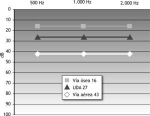 Audiometría preoperatoria: umbral auditivo medio (UAM).