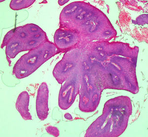 Imagen microscópica de papiloma escamoso laríngeo. Tinción de hematoxilina y eosina. Se aprecia el aspecto digitiforme del papiloma, con los ejes conjuntivo-vasculares, cortados transversal y longitudinalmente.