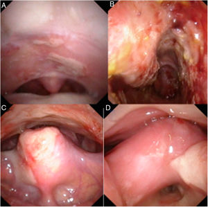 Se observan lesiones vesículo-ampollosas, erosivas y hemorrágicas, edema y zonas con depósitos de fibrina en mucosa nasal y de faringolaringe. A) Orofaringe. B) Fosa nasal derecha. C) Cara lingual de epiglotis. D) Edema y sinequia interaritenoidea, reducción del vestíbulo laríngeo.
