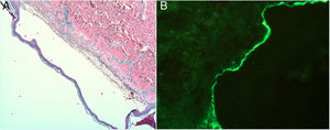 Biopsia cutánea del paciente. A) Se observa una ampolla subepidérmica, con epidermis de aspecto normal y sin alteraciones de la queratinización. La cavidad ampollar contiene fibrina con polvillo nuclear y neutrófilos. El suelo de la ampolla corresponde a la dermis papilar que muestra un infiltrado perivascular de linfocitos e intersticial de neutrófilos, con prácticamente ausencia de eosinófilos (tinción hematoxilina-eosina ×4). B) Inmunofluorescencia directa en la que se observa una banda lineal de IgA en la membrana basal (magnificación ×400).