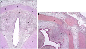 Secciones transversales de un feto de 11 semanas (hematoxilina-eosina) cerca del plano glótico (A) y del hueso hioides (B). 1. Lámina intermedia del cartílago tiroides; 2. lámina lateral del cartílago tiroides; 3. proceso en zona media; 4. fibras musculares del plano glótico; 5. hueso hioides; 6. cartílago cricoides; 7. futuro espacio preepiglótico (reproducción de imágenes con permiso del autor).