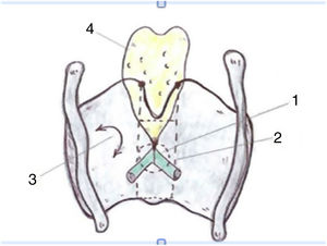 Definición de la comisura anterior (AC) de la laringe propuesta (vista posterior). 1. «Clásica» AC: inserción del nivel glótico excluyendo el cartílago tiroides; 2. «Desarrollada» AC: 3 niveles de inserción (supra, glótico y subglótico) incluyendo la lámina intermedia del tiroides. 3. lámina lateral del tiroides; 4. cartílago epiglótico (reproducción de imágenes con permiso del autor).