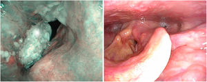 Imagen con luz blanca y con NBI de neoplasia de cuerda vocal derecha con afectación de la comisura.