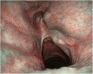 Imagen de cordectomía y resección de la comisura anterior con NBI (keyhole).