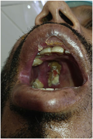 Oral necrotic lesion. Written informed consent was obtained from the participant of the study.