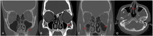 (A through C) Coronal computed tomography (CT) scans of paranasal sinus, (A and B) showing mild mucosal thickening (red arrow) and (C) air fluid level and air bubbles within fluid level (red arrow). (D) Axial CT scan of paranasal sinus showing mucosal necrosis of the left inferior turbinate (red arrow).