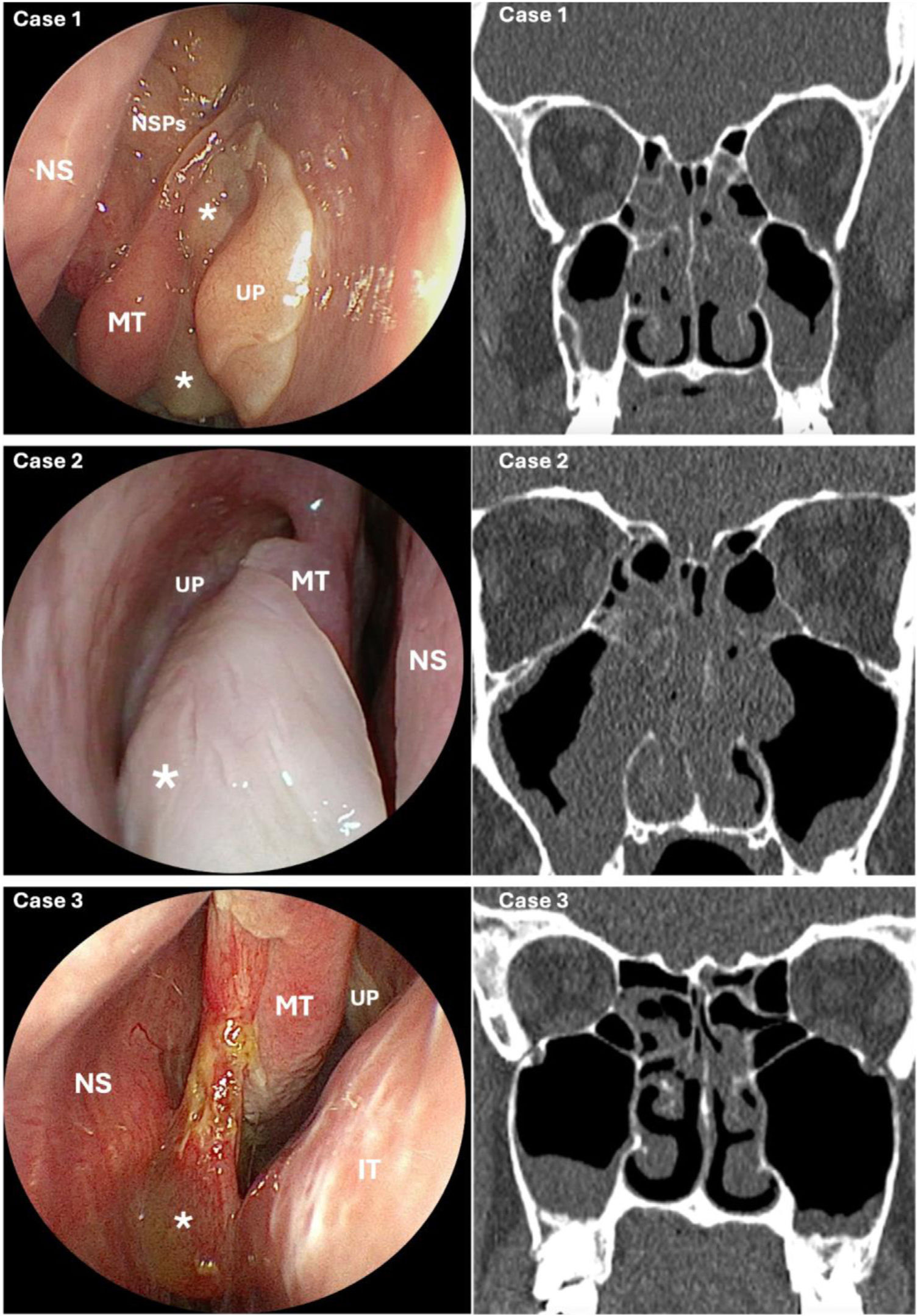 Diagnostic challenges of central compartment atopic disease in type-2 ...