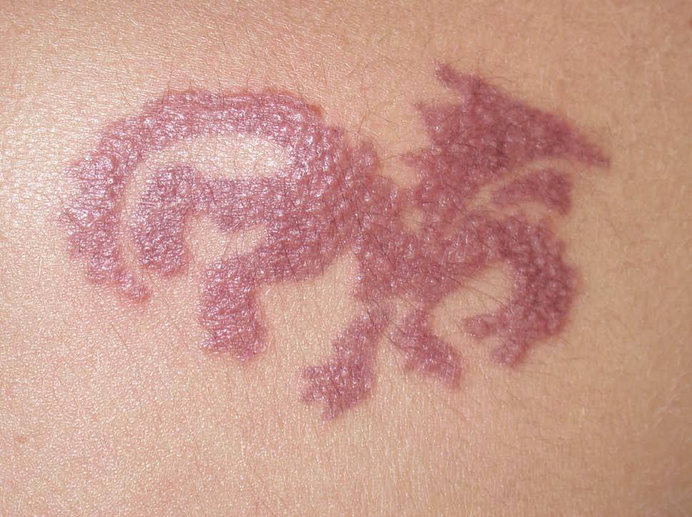 Dermatitis de contacto alérgica a tatuajes temporales de henna
