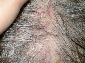 Lesiones residuales en cuero cabelludo de la misma paciente tras tres infusiones de rituximab intravenoso. Fuente: Esposito M, et al205.