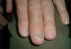 Paciente con artritis psoriásica (a modo de dactilitis) y psoriasis ungueal (onicolisis y manchas de aceite).