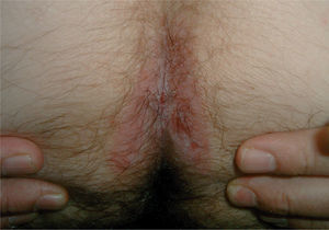 Psoriasis del pliegue interglúteo, que suele acompañar a la psoriasis ungueal y artropática, especialmente en varones.