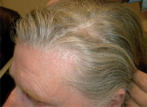 Psoriasis del cuero cabelludo, especialmente asociado a la psoriasis ungueal.