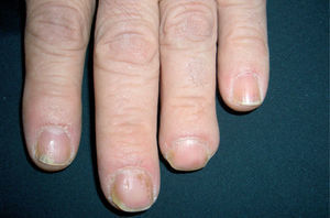 Manchas de aceite. Siempre consideradas patognomónicas de la psoriasis, suelen ser redondeadas y como en este caso aisladas. Lo habitual es que coexistan con otras lesiones, en esta paciente se aprecian hemorragias en astilla.