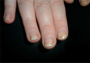 Onicolisis psoriática. Es característico el ribete en forma de mancha de aceite y nos ayuda a diferenciarla de otras causas de onicolisis.