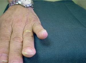 Hiperqueratosis subungueal junto a otras lesiones de psoriasis.
