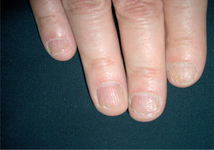 Paciente con psoriasis ungueal de predominio matricial (pitting) y ligera hiperqueratosis subungueal.