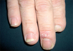 Paroniquia psoriásica.