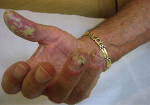 Acrodermatitis continua de Hallopeau.