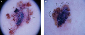 Se muestran dos melanomas de patrón multicomponente. A. Melanoma de extensión superficial 0,5 mm Breslow. Presenta manchas de pigmento de diferente coloración, puntos y glóbulos irregulares en periferia (flechas) y velo azul gris central. Pueden identificarse áreas de regresión gris y blanca (cuadrado), y estructuras vasculares atípicas (óvalo). B. Melanoma de extensión superficial de 0,8 mm de Breslow. Detaca la presencia de una mancha de pigmento homogéneo central con áreas de velo azul gris, y en la periferia la existencia de un retículo pigmentado prominente (flecha), glóbulos irregulares (óvalo) y pseudópodos (cículo).