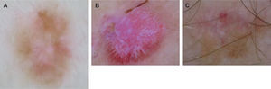 Se muestran tres lesiones de patrón inespecífico en los que la asimetría, la presencia de vascularización atípica y los restos de pigmento melánico orientan al diagnóstico de melanoma. A. Melanoma de extensión superficial 0,7 mm de Breslow. B. Melanoma nodular amelanótico de 1,5 de Breslow. C. Melanoma in situ.