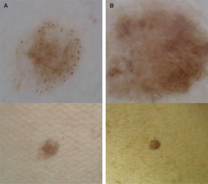 La figura muestra dos casos de melanoma poco expresivos clínicamente, con hallazgos dermoscópicos relevantes para el diagóstico. A. Melanoma in situ que presenta un patrón globular atípico sugestivo de melanoma. B. Melanoma in situ que muestra asimetría, zonas de retículo pigmentado irregular y glógulos de distribución irregular junto a áreas de fibrosis cicatricial.