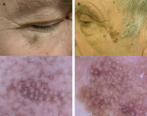 Las imágenes corresponden a dos melanomas tipo léntigo maligno de la cara. A. Lesión pigmentada facial que muestra un pseudorretículo pigmentado con presencia de puntos y glóbulos de color gris pizarra, conformando imágenes granulares en anillo. B. Lesión facial en la que se observa un pseudorretículo pigmentado con presencia de estructuras romboidales. Estos hallazgos son específicos del melanoma léntigo maligno facial en fases iniciales de su evolución.