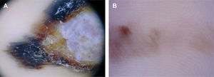 A. Melanoma lentiginoso acral de 8 mm de Breslow. Detalle de la periferia de la lesión que muestra un patrón de la cresta característico de los melanomas en estas localizaciones. B. Melanoma in situ acral. Se aprecia una lesión hipomelanótica asimétrica que exhibe un patrón fibrilar.