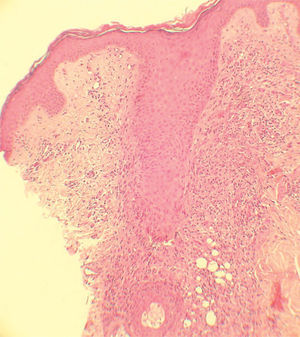Inflamación granulomatosa alrededor del folículo piloso (hematoxilina-eosina, ×40).