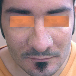 Eritema facial y escamas amarillentas en surcos nasogenianos y pliegue interciliar.