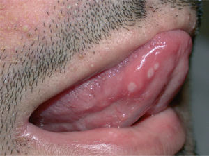 Úlceras puntiformes en la lengua.