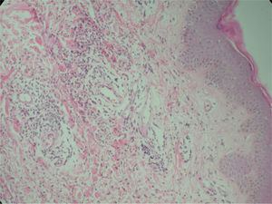 Edema e intenso infiltrado inflamatorio de predominio neutrofílico en la dermis (HE ×250).