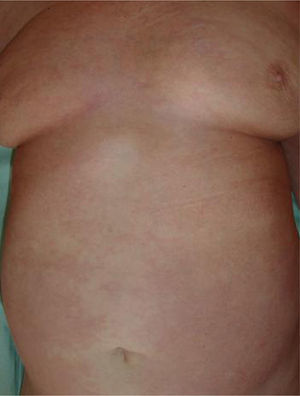 Máculas y manchas hiperpigmentadas residuales tras el tratamiento con dapsona.
