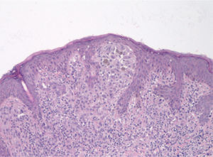 Proliferación de células epitelioides y fusiformes (hematoxilina-eosina, 100×).