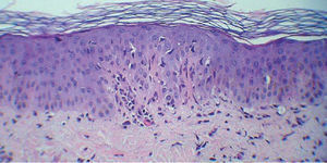 Vacuolización de la basal e infiltrado inflamatorio en la dermis papilar. Hematoxilina-eosina ×20.