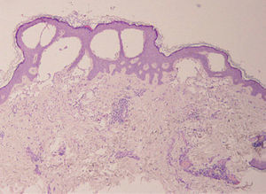 Marcada dilatación vascular en la dermis papilar que protuía hacia la epidermis. Hematoxilina-eosina.