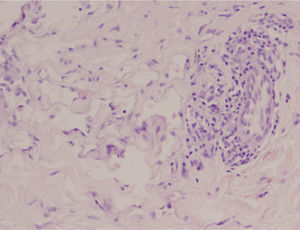 Espacios vasculares tapizados por una única hilera de células endoteliales con núcleos ovales hipercromáticos que protruían hacia la luz. Hematoxilina-eosina.