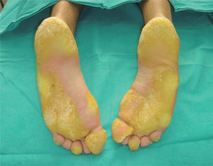 Queratodermia plantar compacta que afecta de forma predominante a la cabeza del primer y quinto metatarsianos, dedo hallux y talones, donde adquiere forma de herradura.