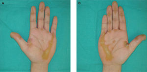 Disposición lineal en palmas con afectación preferente de las zonas de apoyo y caras flexoras de los dedos (A). Las lesiones tienen un claro predominio por la mano derecha (B).