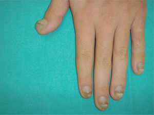 Onicodistrofia de las 20 uñas.