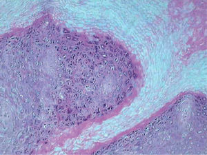 Hiperqueratosis ortoqueratótica marcada con intensa hipergranulosis y acantosis. Hematoxilina-eosina, ×100.